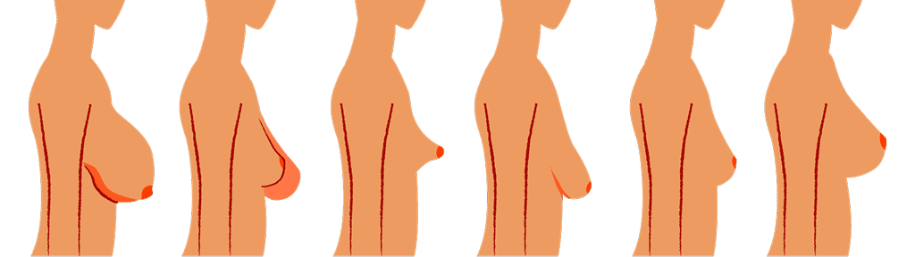 Mamoplastia 1